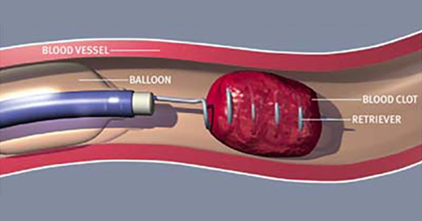 A “Miracle” ClotBusting Treatment for Stroke